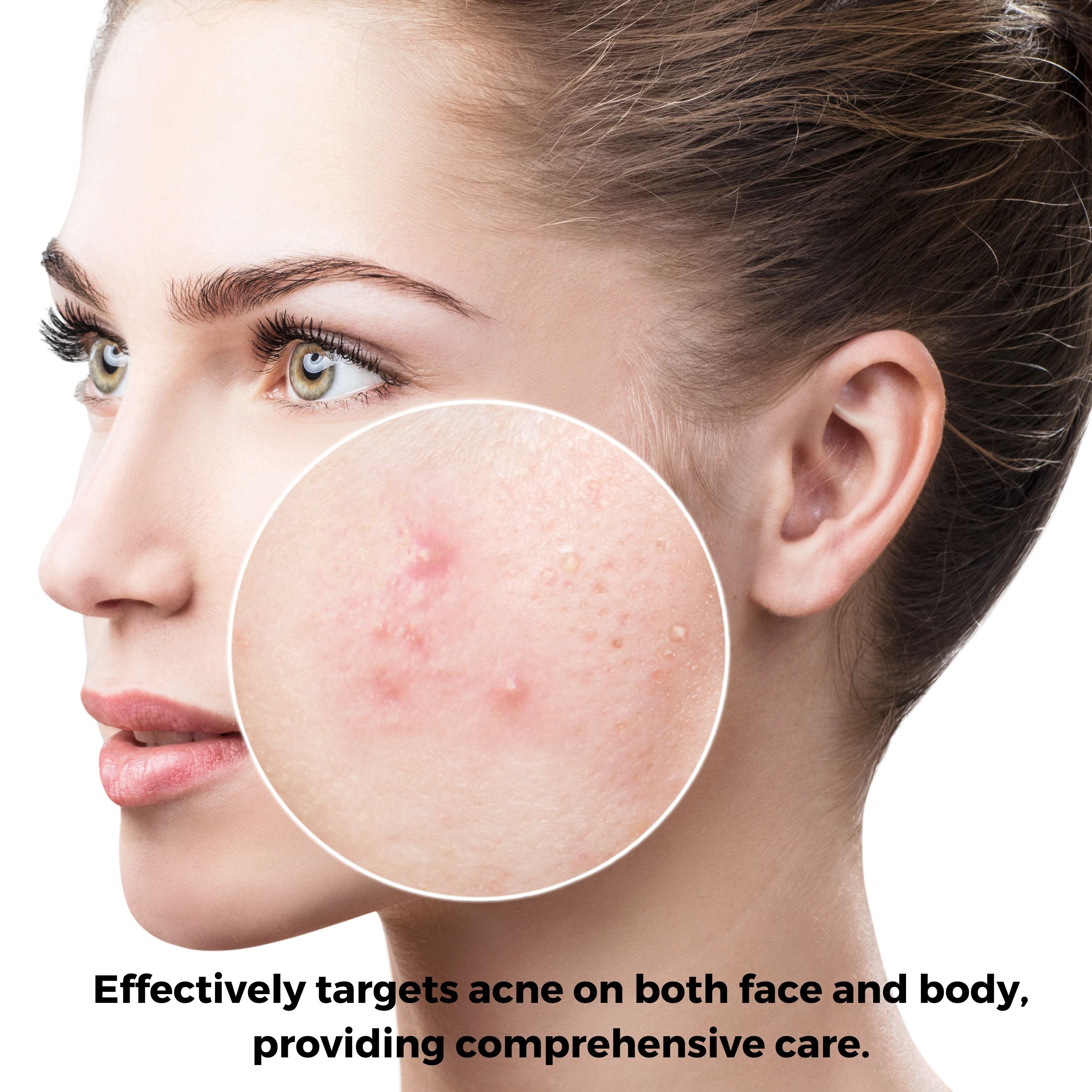 Acne Wash 50mL – Extra Strength Foaming Cleanser that helps fight acne and prevent future breakouts.