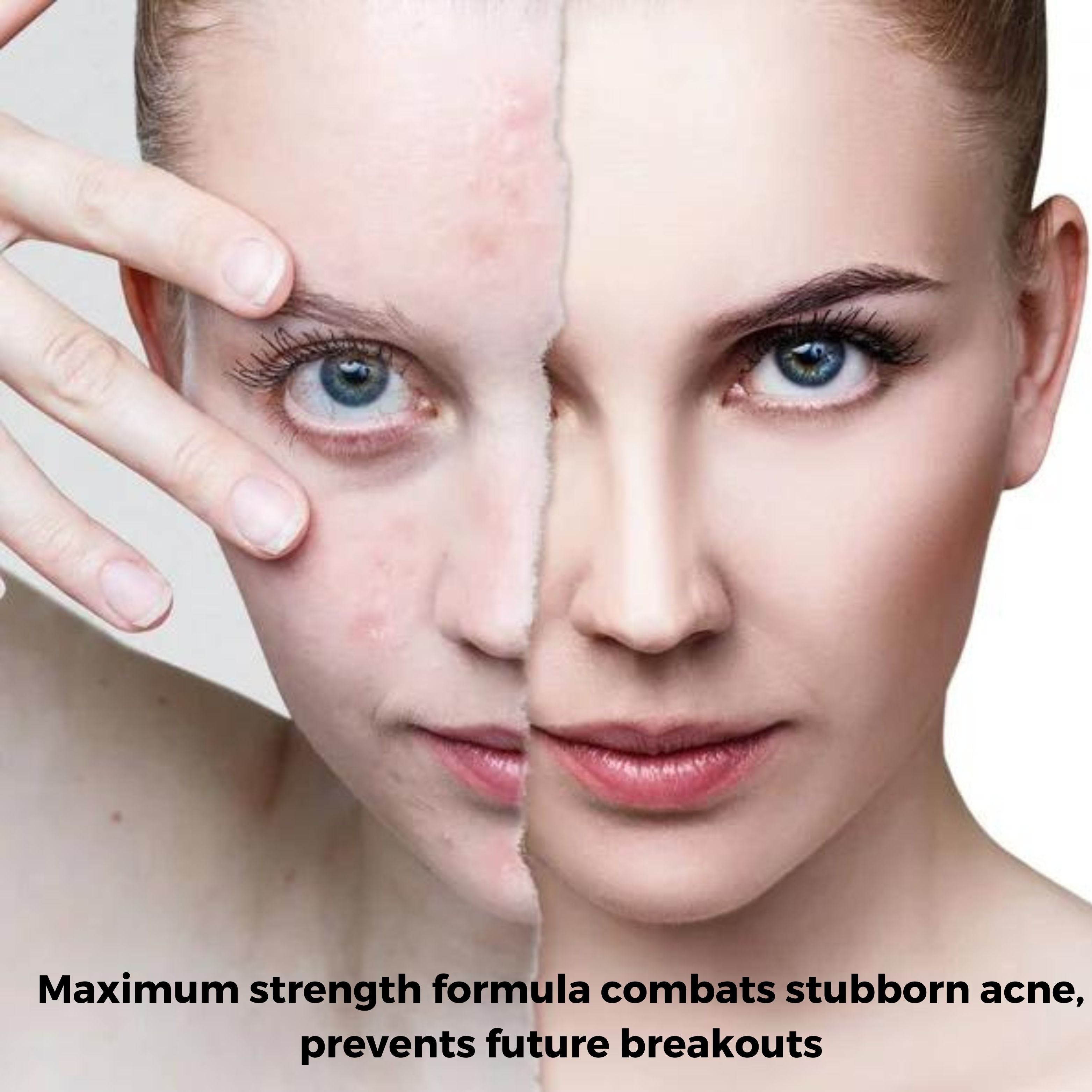 Acne Treatment Foaming Cleanser – 50mL bottle of extra strength formula for clear, refreshed skin.